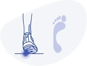 What is underpronation? Ground Contact: When landing, the outside of your heel lands first at an increased angle with little to no rolling (pronation). Push-Off: Pressure is focused on the outside of your foot and smaller toes. Foot Type: High arches. Potential Injuries: Shin splints, plantar fasciitis, ankle strain. Recommended Shoes: Shoes with extra cushioning.